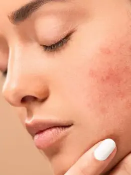 Skin appears clearer after taking an efficient acne treatment and has a noticeable reduction in acne