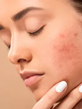 A woman shows her acne-ridden face, while covering her nails with white polish & shutting her eyes