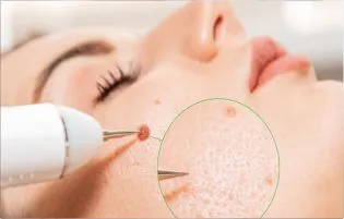 A woman having skin tags removed from her body and face using skin care procedures from experts.
