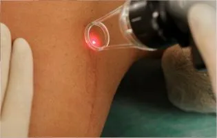 A woman receiving laser skin care treatment from skin care doctors to remove warts on her body.