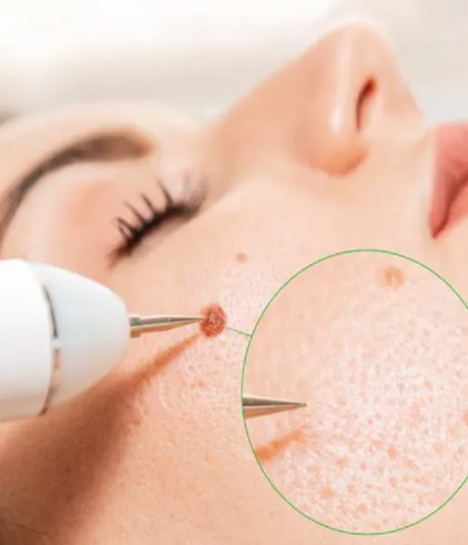 A woman having skin tags removed from her body and face using skin care procedures from experts.