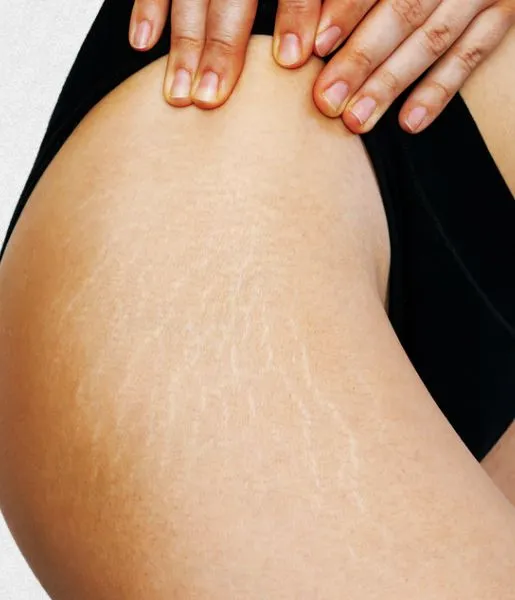 Patient shows her arms, which are covered with many stretch marks as a result of her poor skin care.