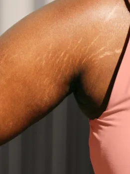 A woman wearing a pink dress shows her arm, which has multiple stretch marks and an odd skin tone.
