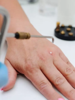 A patient is undergoing a needle treatment for their hands to promote quicker healing and recovery.