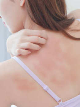 A woman has a bacterial skin disease on her back, which is causing her to itch; it looks reddish