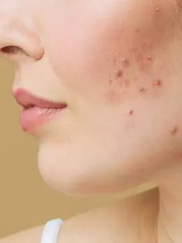 A woman has multiple acne spots, so she needs to take a face acne reduction treatment to a doctor.