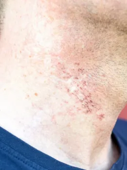 Man wearing a blue outfit has rashes on his neck that to be an allergic reaction or skin irritation.