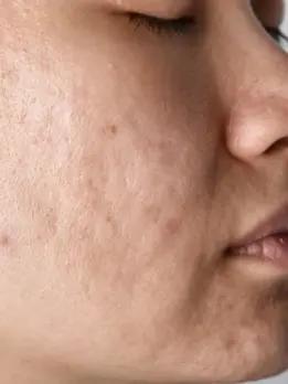 A woman with acne on her face & uneven skin texture, looking sad and in need of expert skin care.