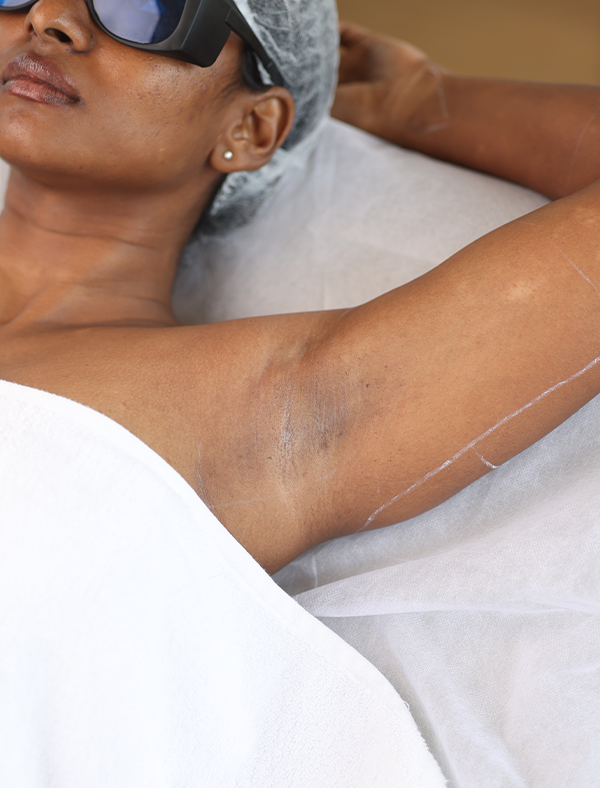 Visible hair growth before laser treatment