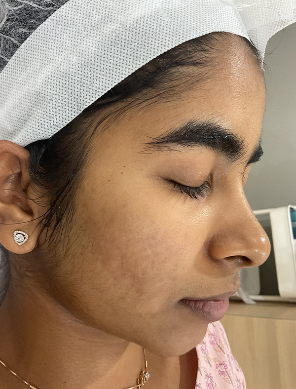 Skin after acne scar treatment
