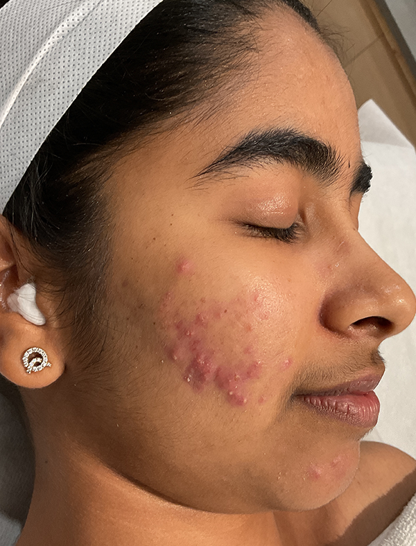 Acne scars before treatment