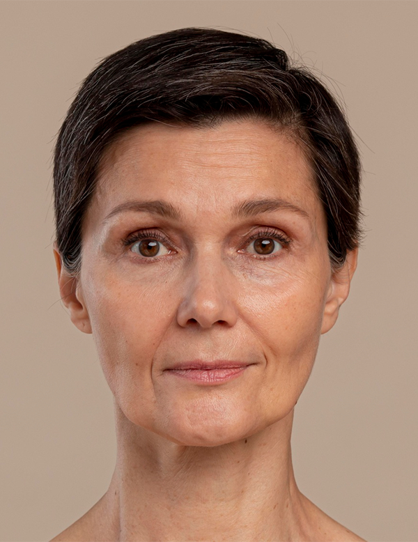 Facial skin with visible fine lines before treatment
