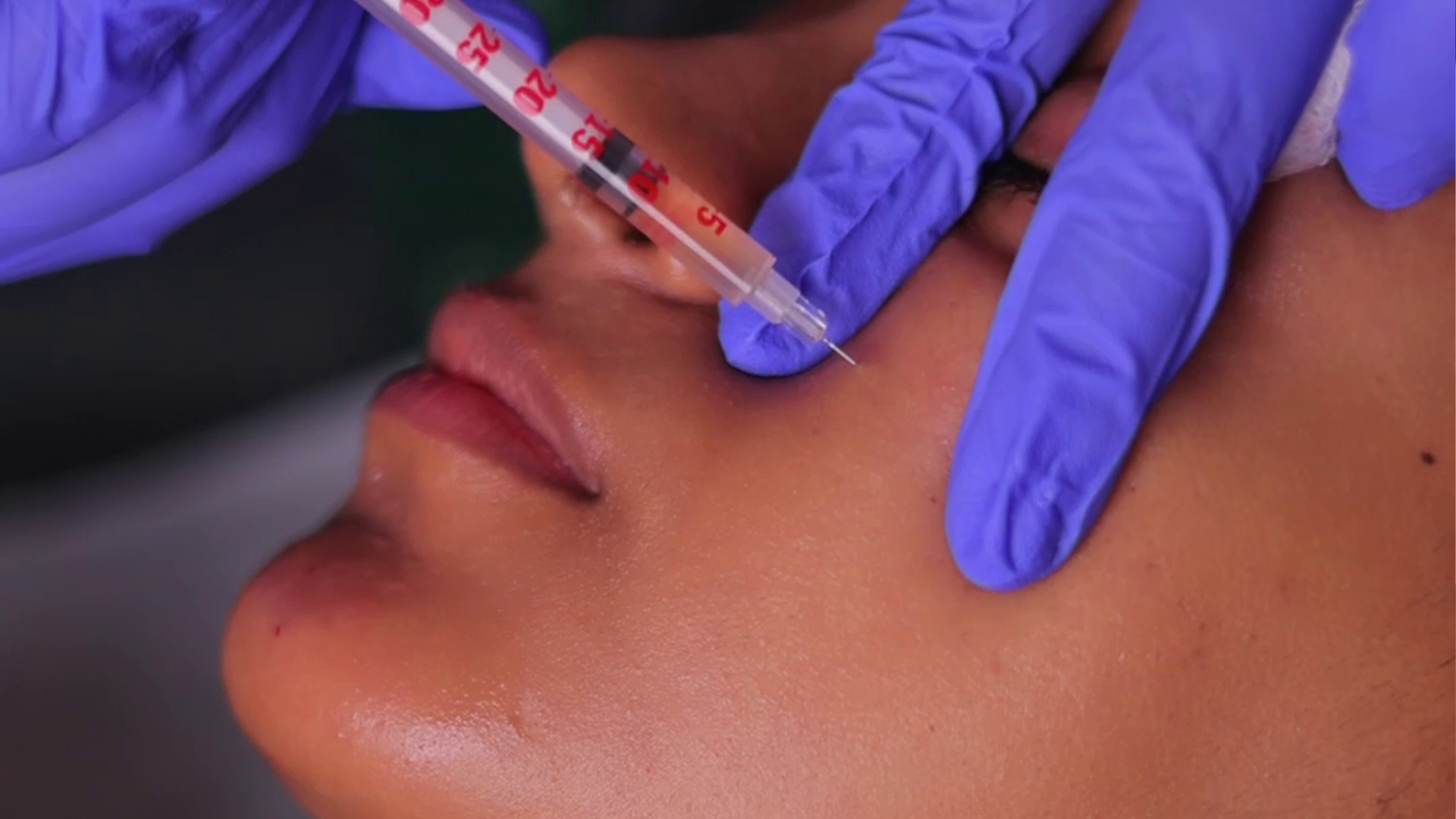 Bio filler PRF facial injection treatment