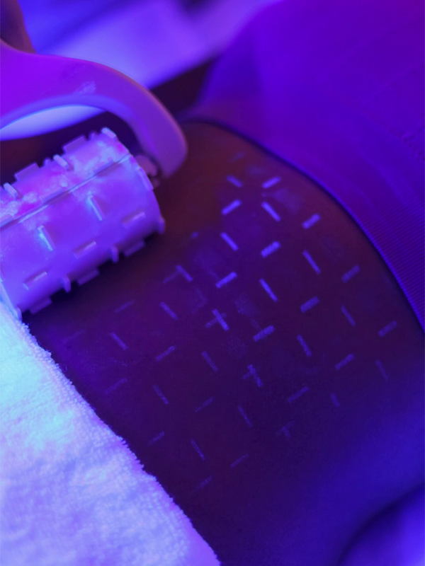 Full body hair reduction procedure