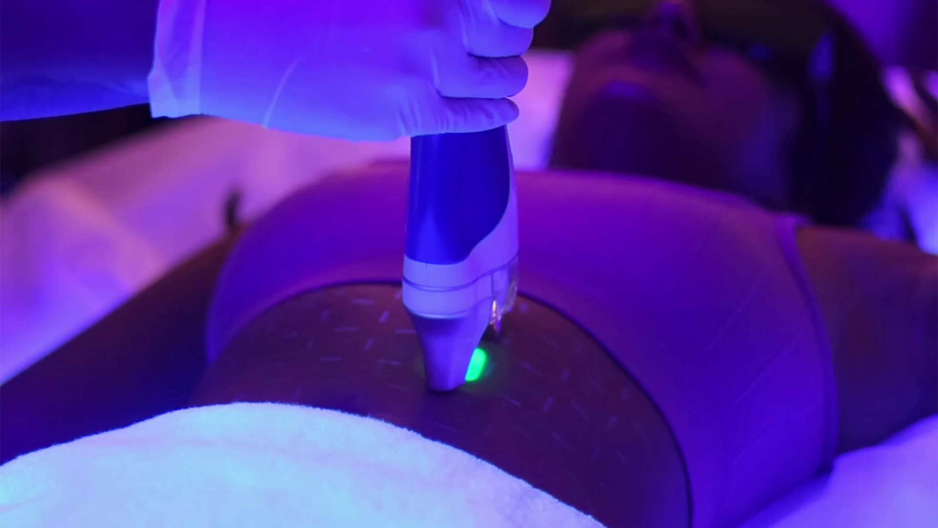 Laser body hair removal treatment