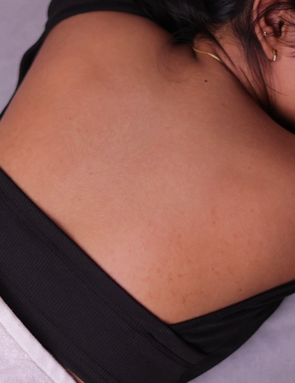 Brighter and smoother body skin after treatment