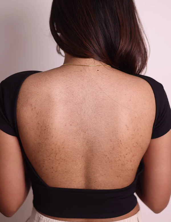 Uneven tanned skin before treatment