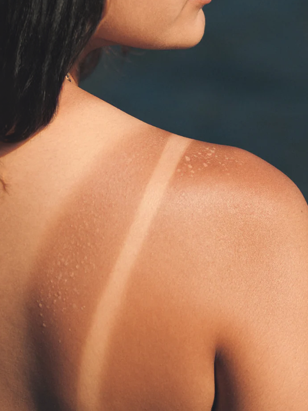 Laser and peel tan reduction therapy