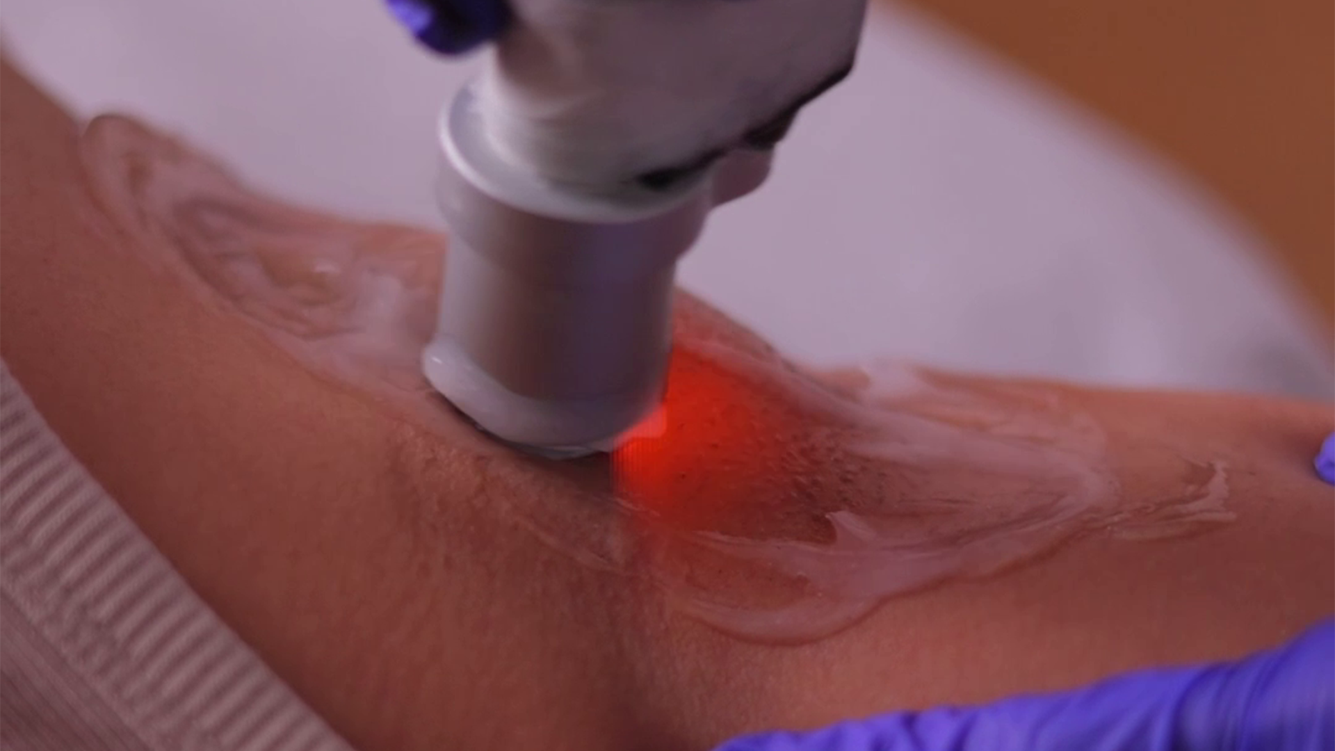 Laser device targeting darkened underarm skin