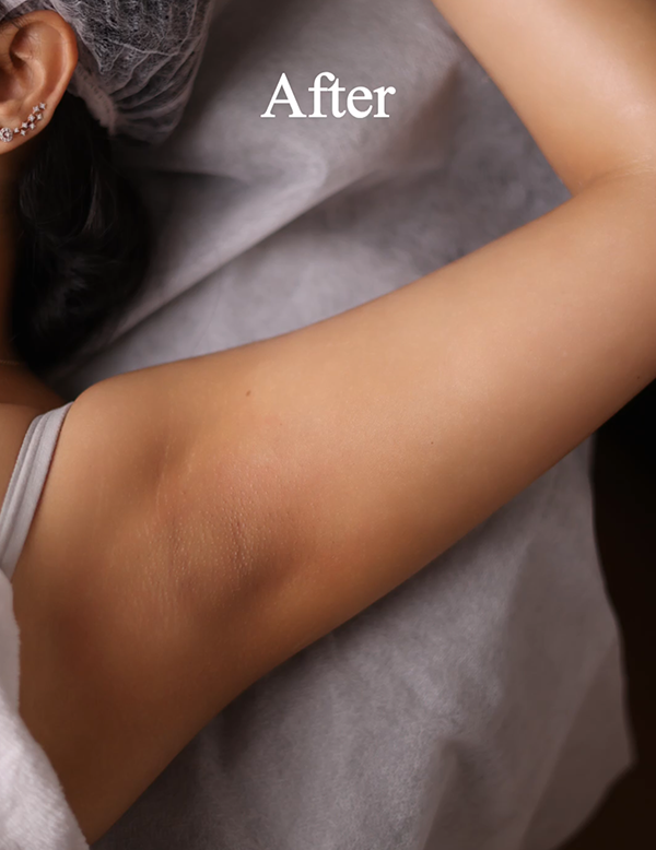 Even-toned and clearer underarm skin after treatment
