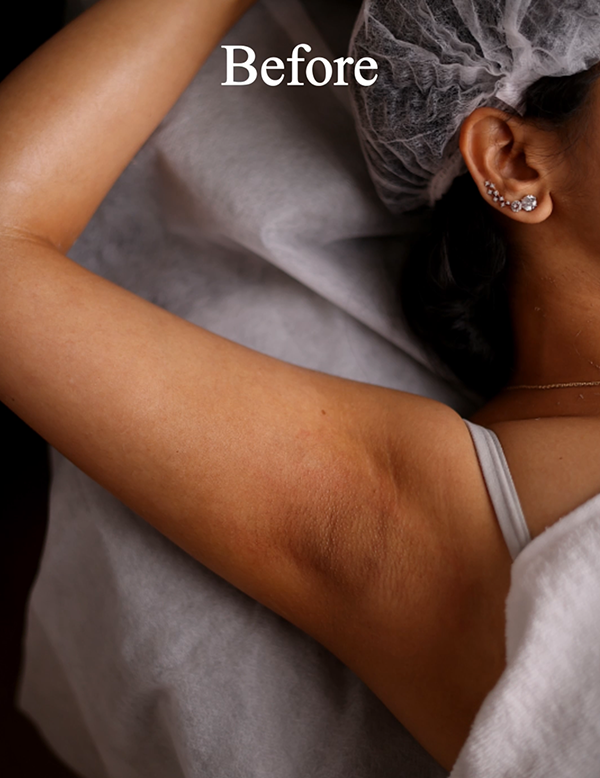 Darkened underarm skin with uneven tone before treatment