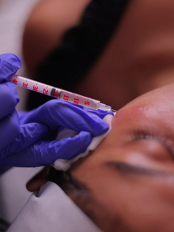 Facial volume restoration with fillers