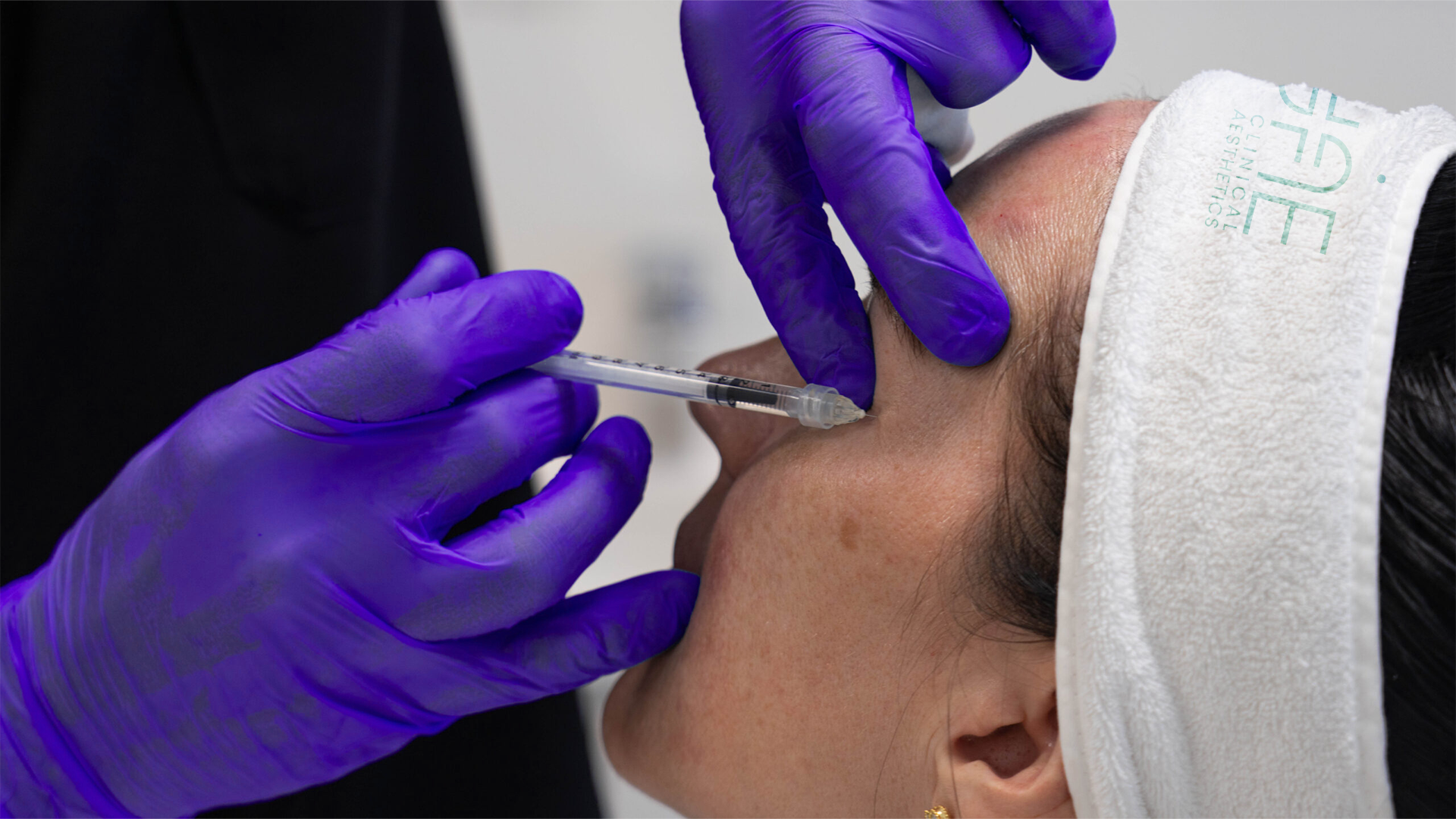 Dermal filler injection treatment