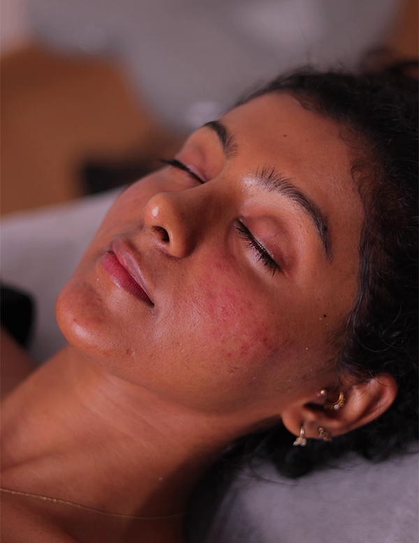 Facial volume loss and lines before filler treatment