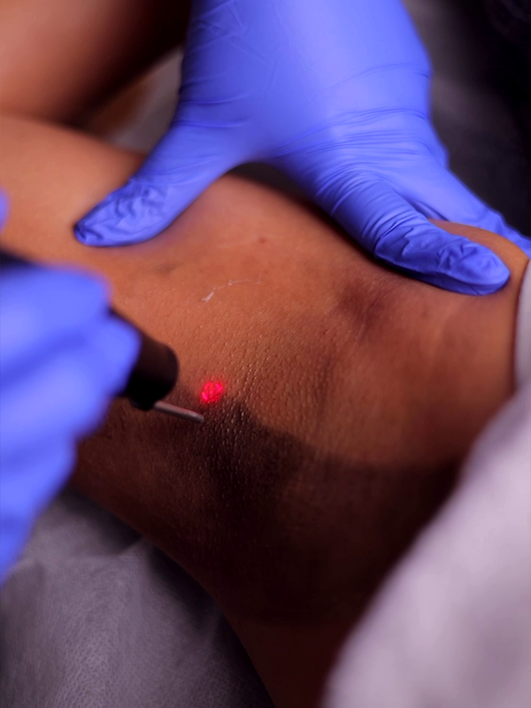 Dermatology procedure targeting dark underarm skin