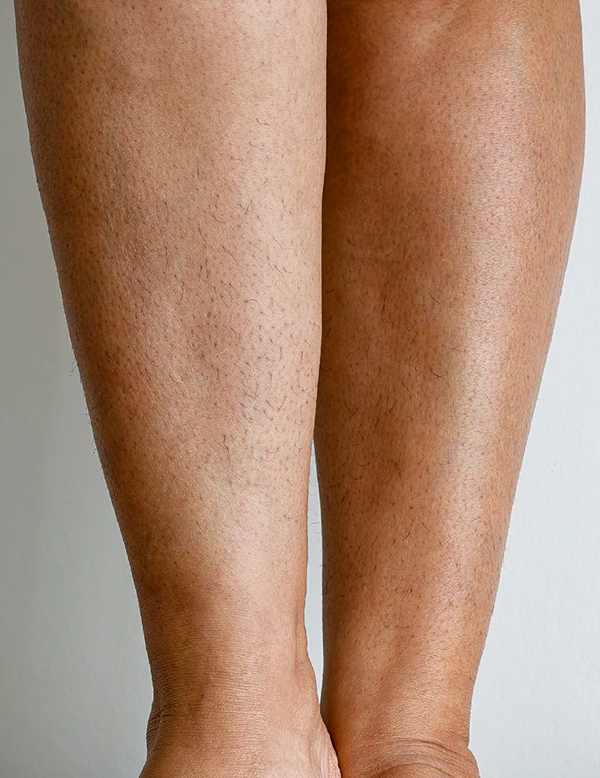 Visible leg hair before treatment