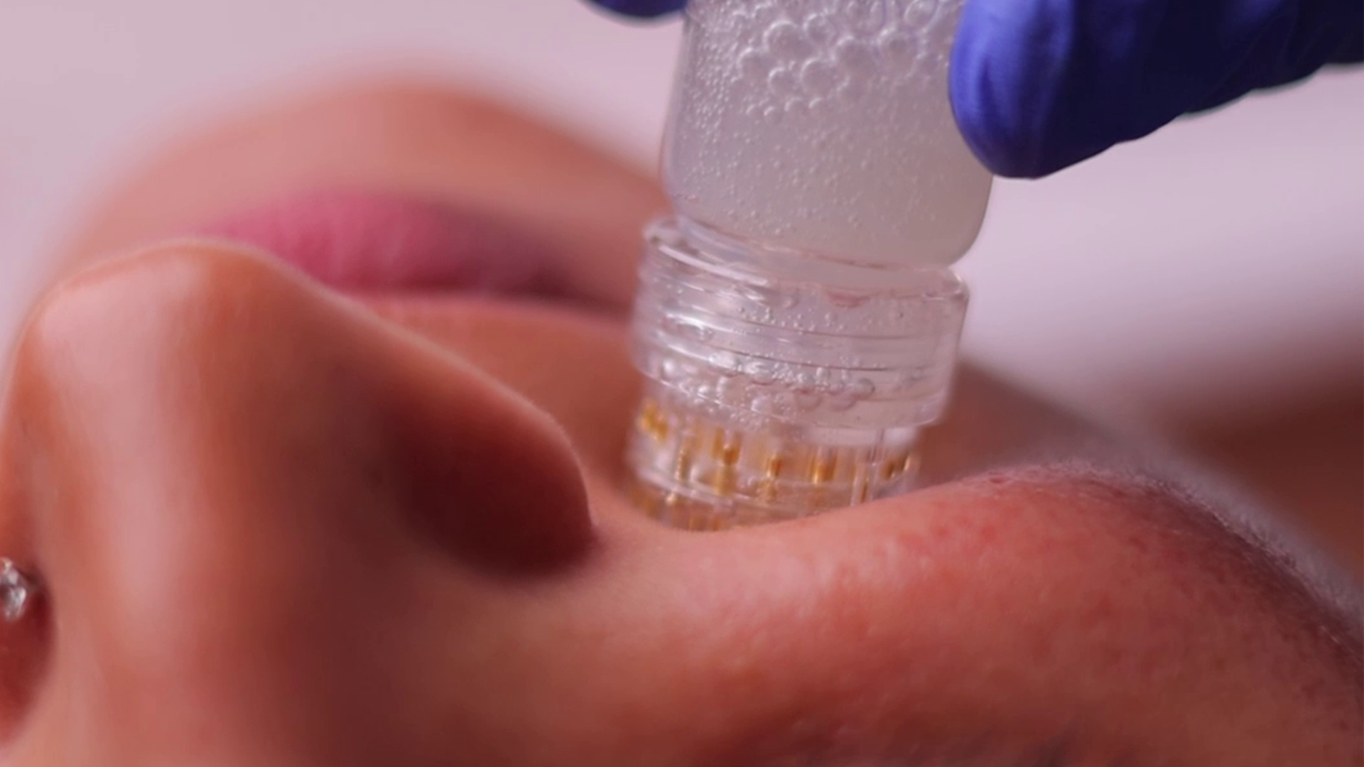 Dermaplaning exfoliation treatment