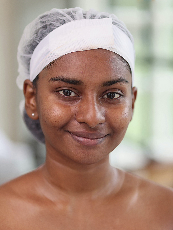 Dull and congested skin before hydrafacial