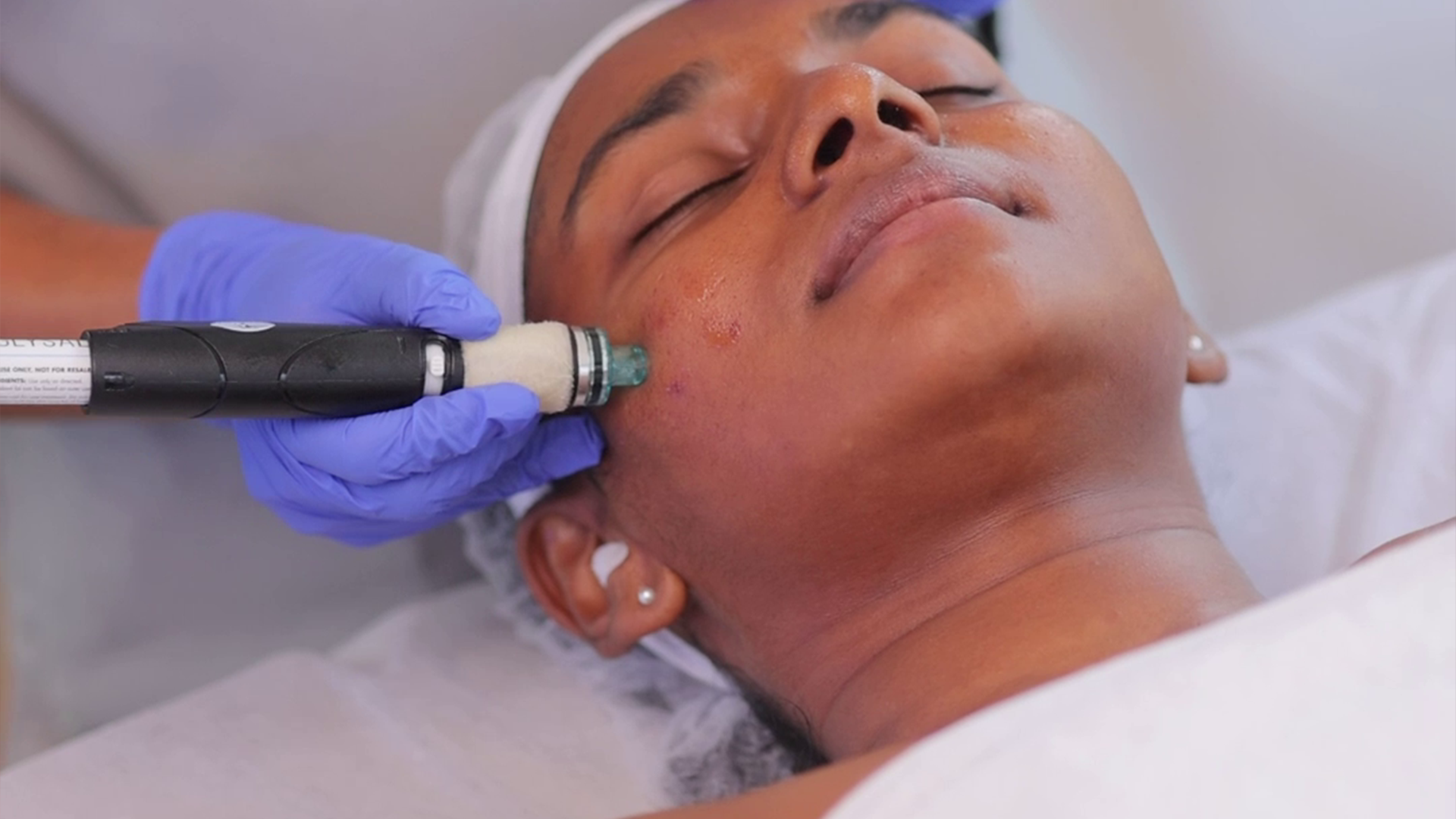 HydraFacial skin treatment