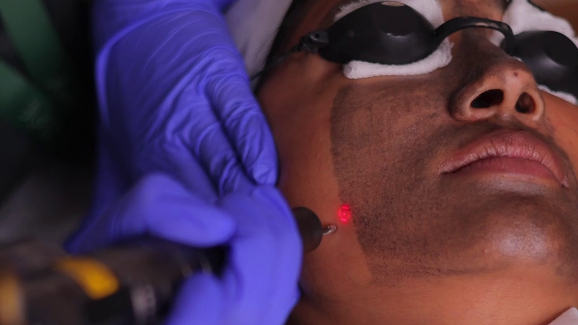 Pigmentation Treatment