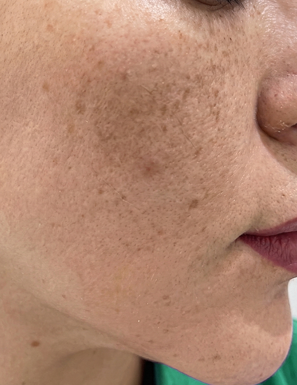 Dark patches from melasma before treatment