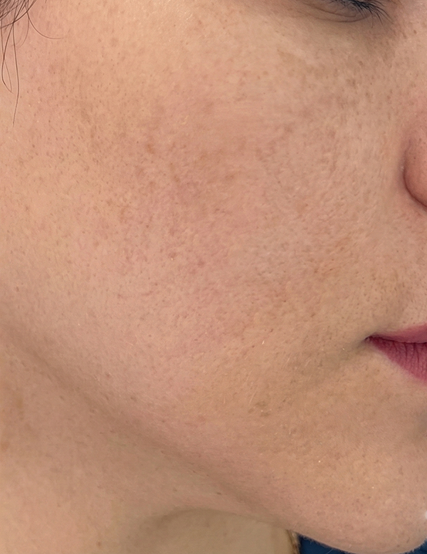 Reduced pigmentation and even skin tone after treatment