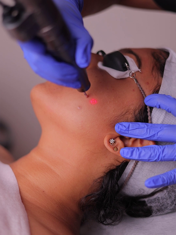 Pigmentation correction therapy for melasma