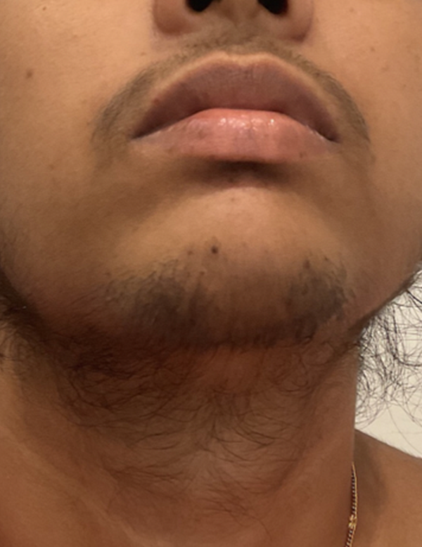 Visible facial hair before treatment