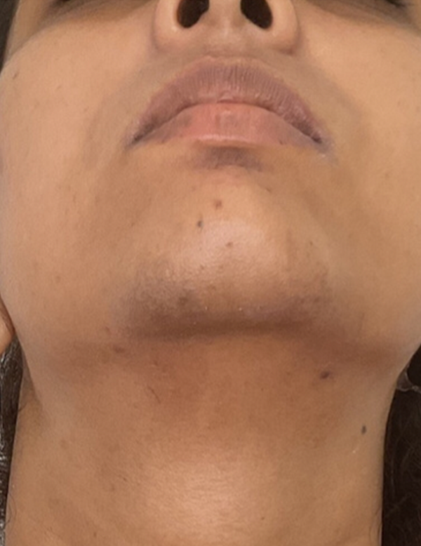 Smooth and hair free facial skin after treatment