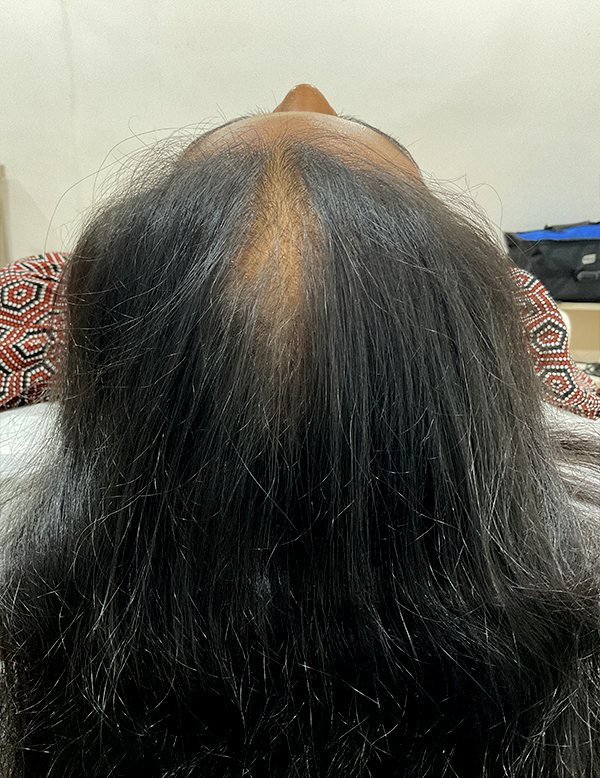 Increased hair growth after treatment