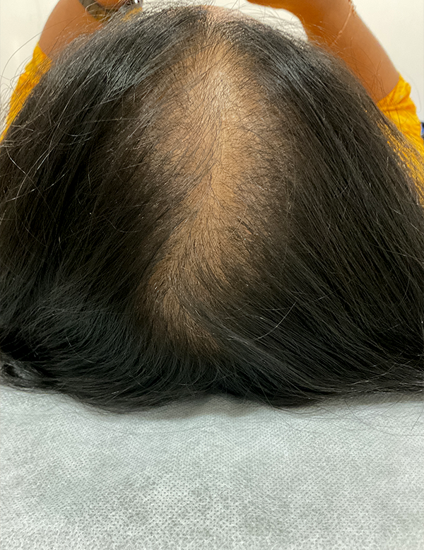Sparse hair growth before treatment