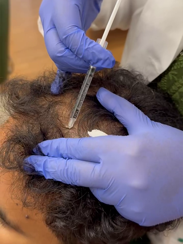 Platelet rich fibrin therapy procedure