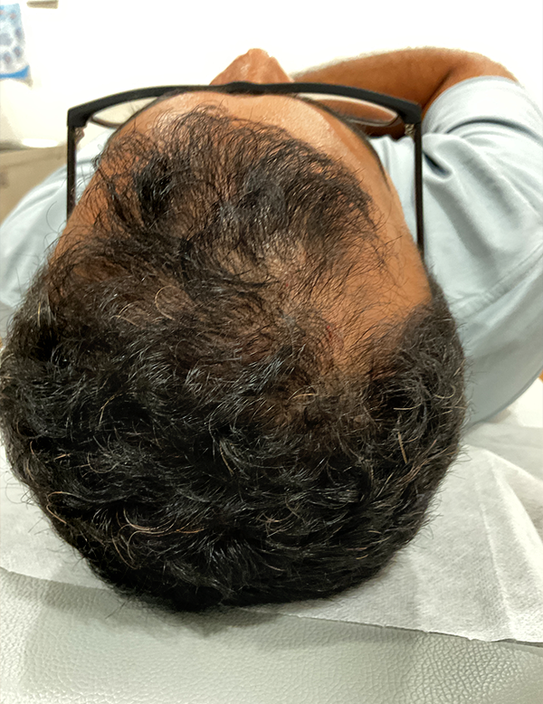 Dull and ageing skin before PRF treatment