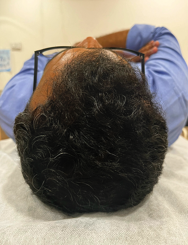 Improved skin texture after PRF treatment