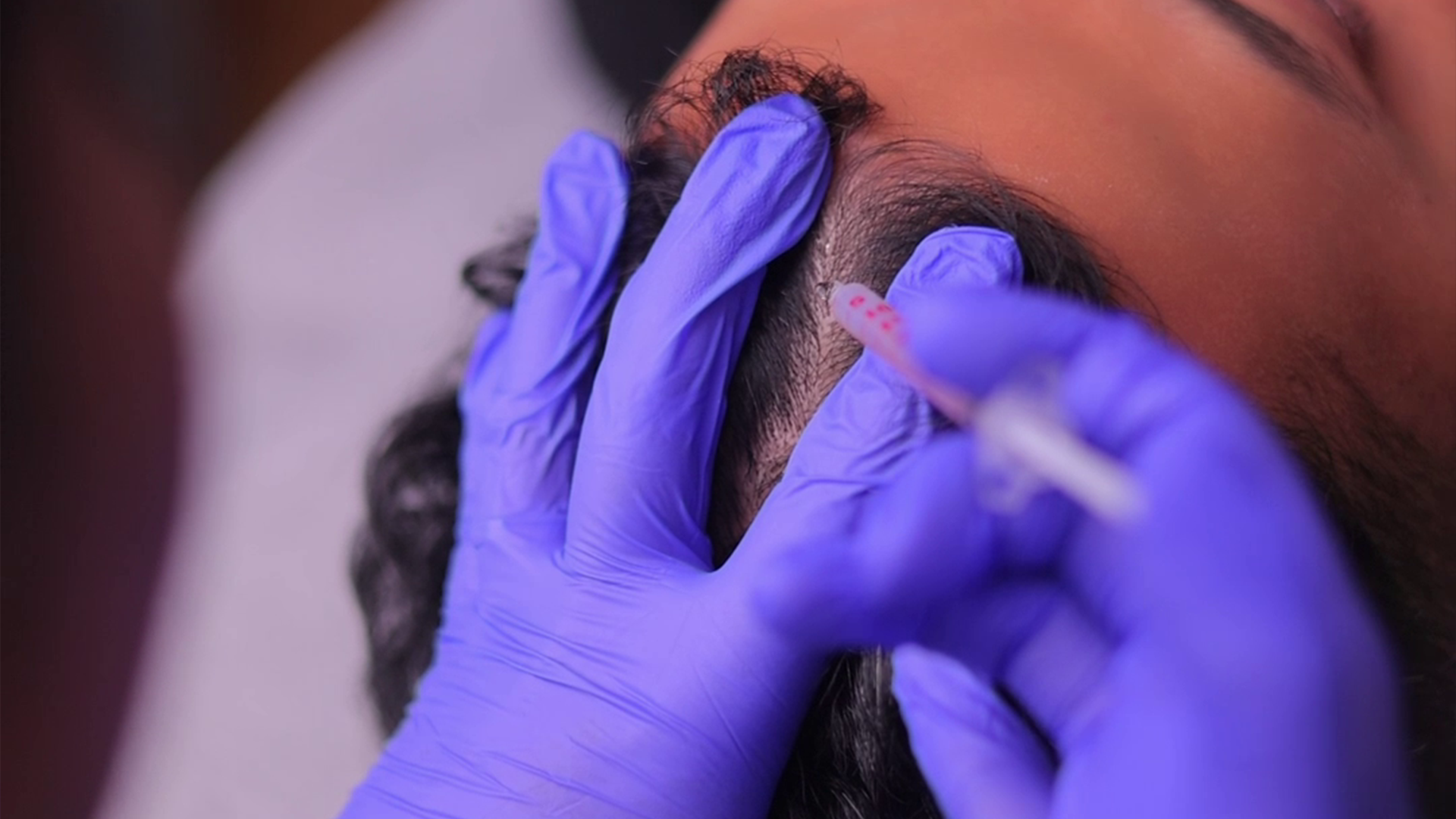 PRF skin rejuvenation treatment