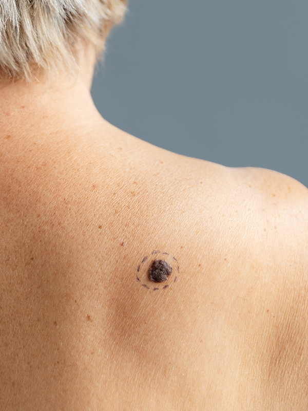 Skin wart on upper back