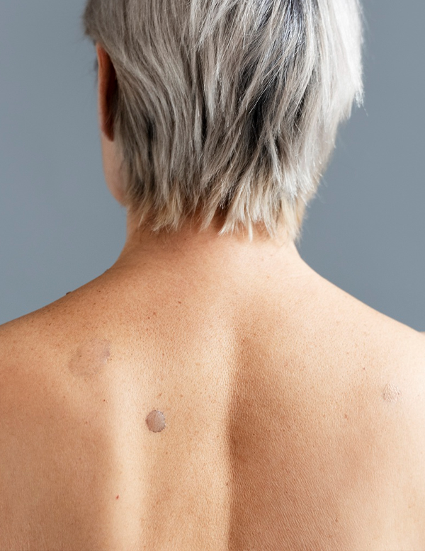 Back skin cleared after treatment