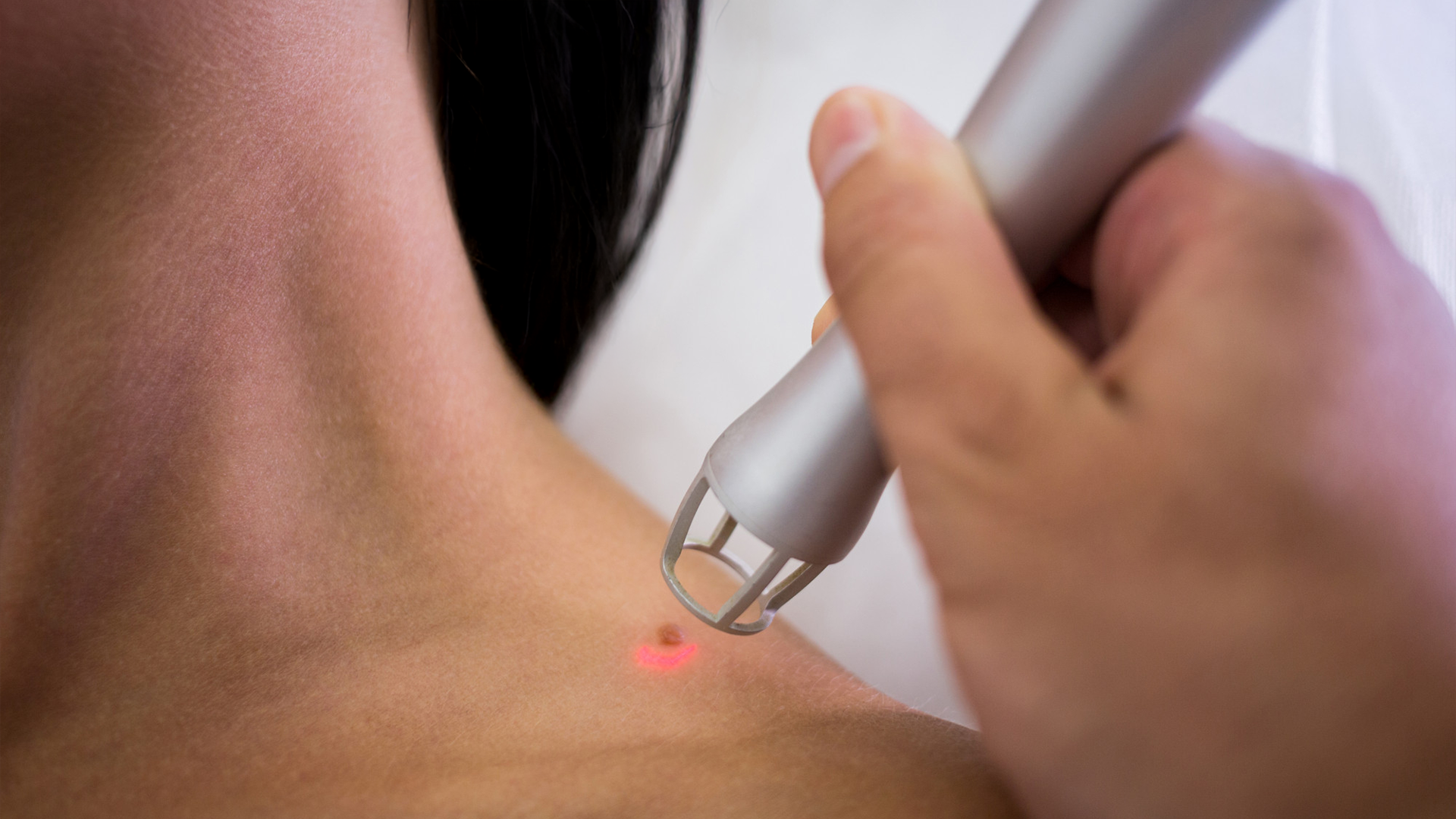 Laser wart removal treatment on neck