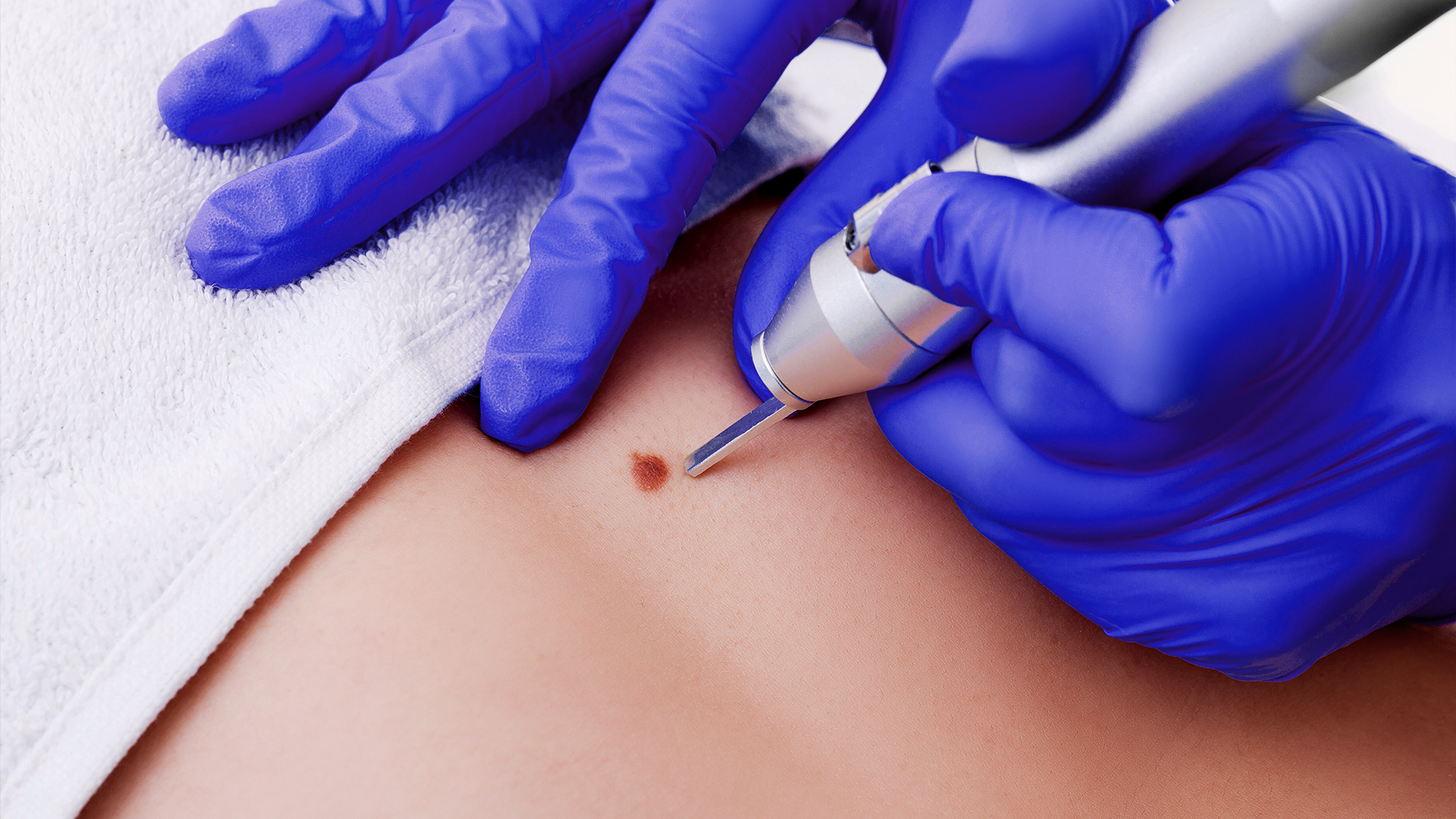 Laser device targeting mole on patient's skin