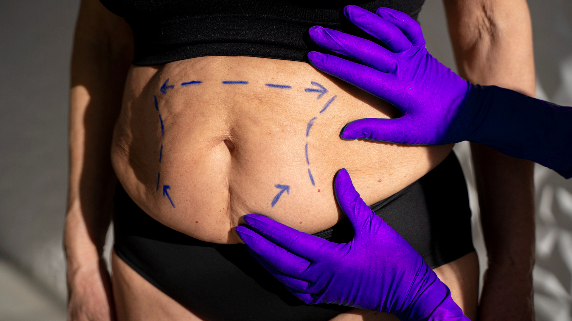 Abdominal skin with visible stretch marks being assessed